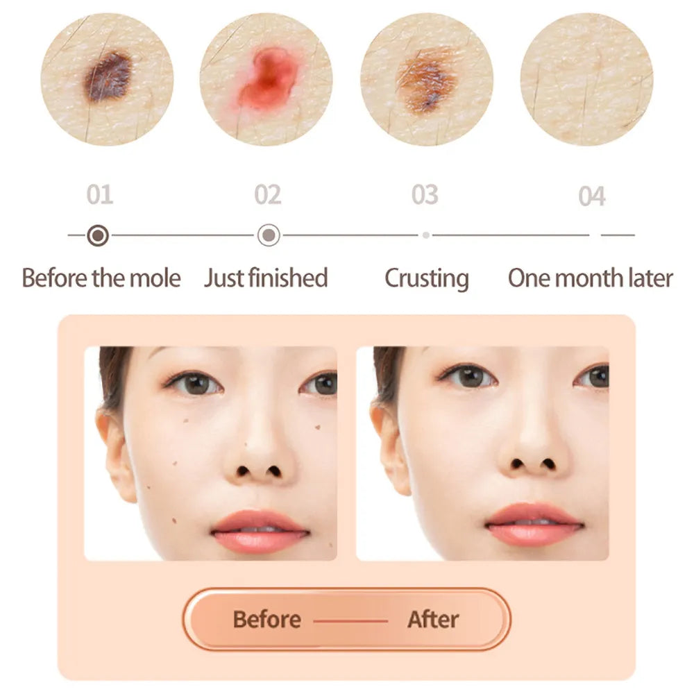 Ouwald Plasma Mole Removal Pen with 9 Modes Adjustment, Portable Freckle Wart Removal Pen Dark Remover For Face Tag Skin Care Blackhead Removers, Rose Gold
