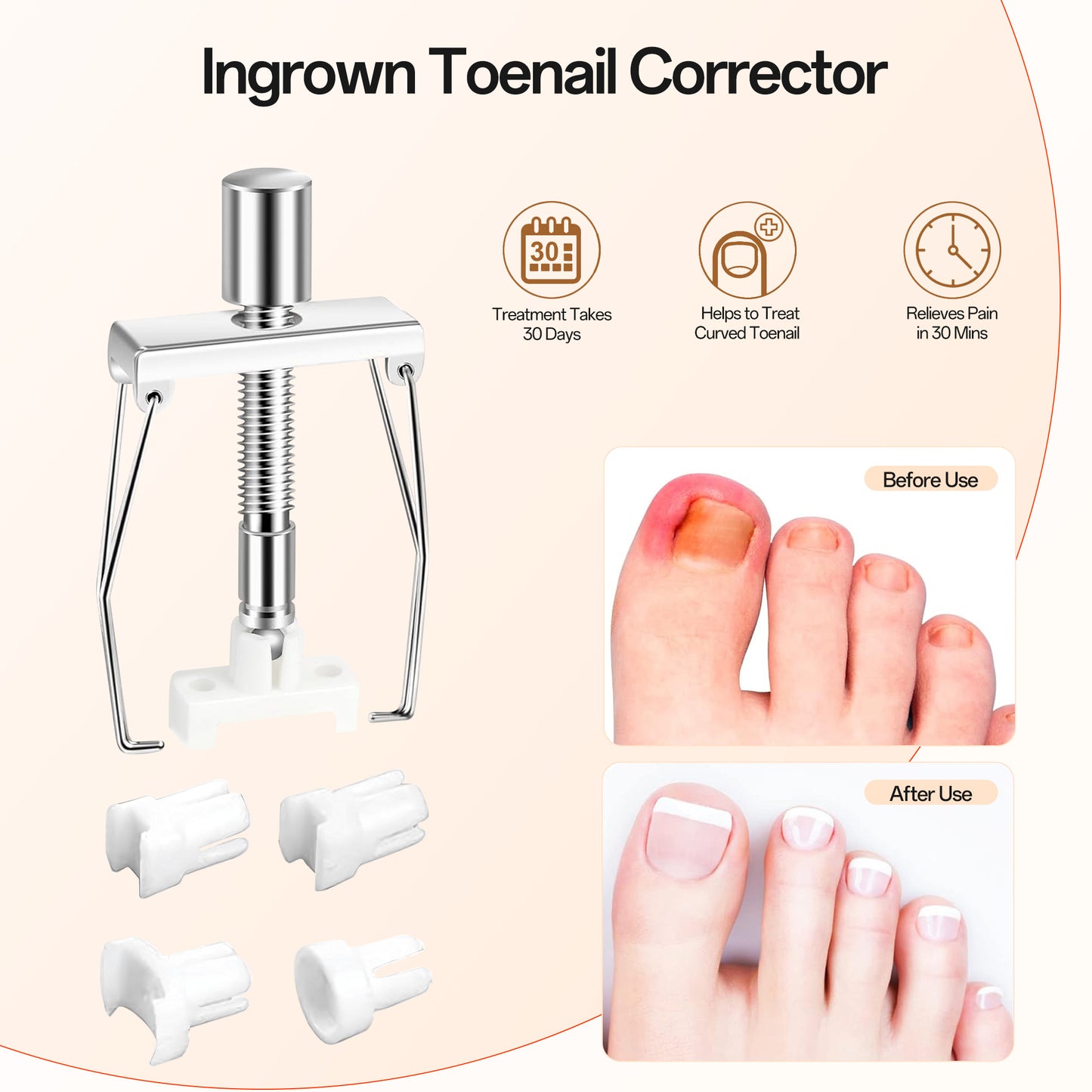 Ouwald Ingrown Toenail Treatment Tools, 84PCS Ingrown Toenail Removal Kit, Ingrown Toenail Corrector, Feet Nail Lift Pedicure Tool