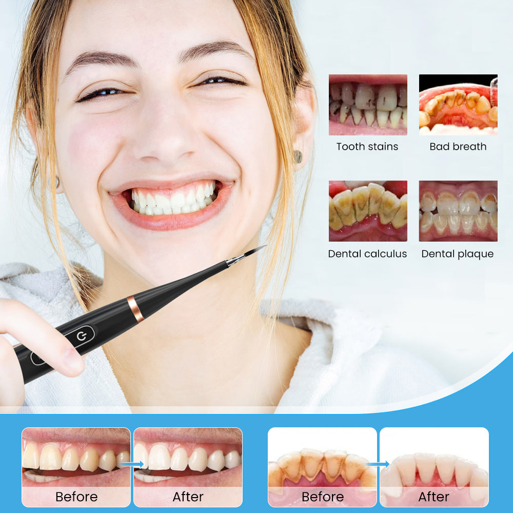 Mieauty 2 In1 Electric Ultrasonic Dental Calculus Remover with 5 Modes, IPX7 Waterproof Rechargeable High Frequency Vibration Electric Toothbrush for Travel & Home Teeth Cleaning Set & Whitening Kit