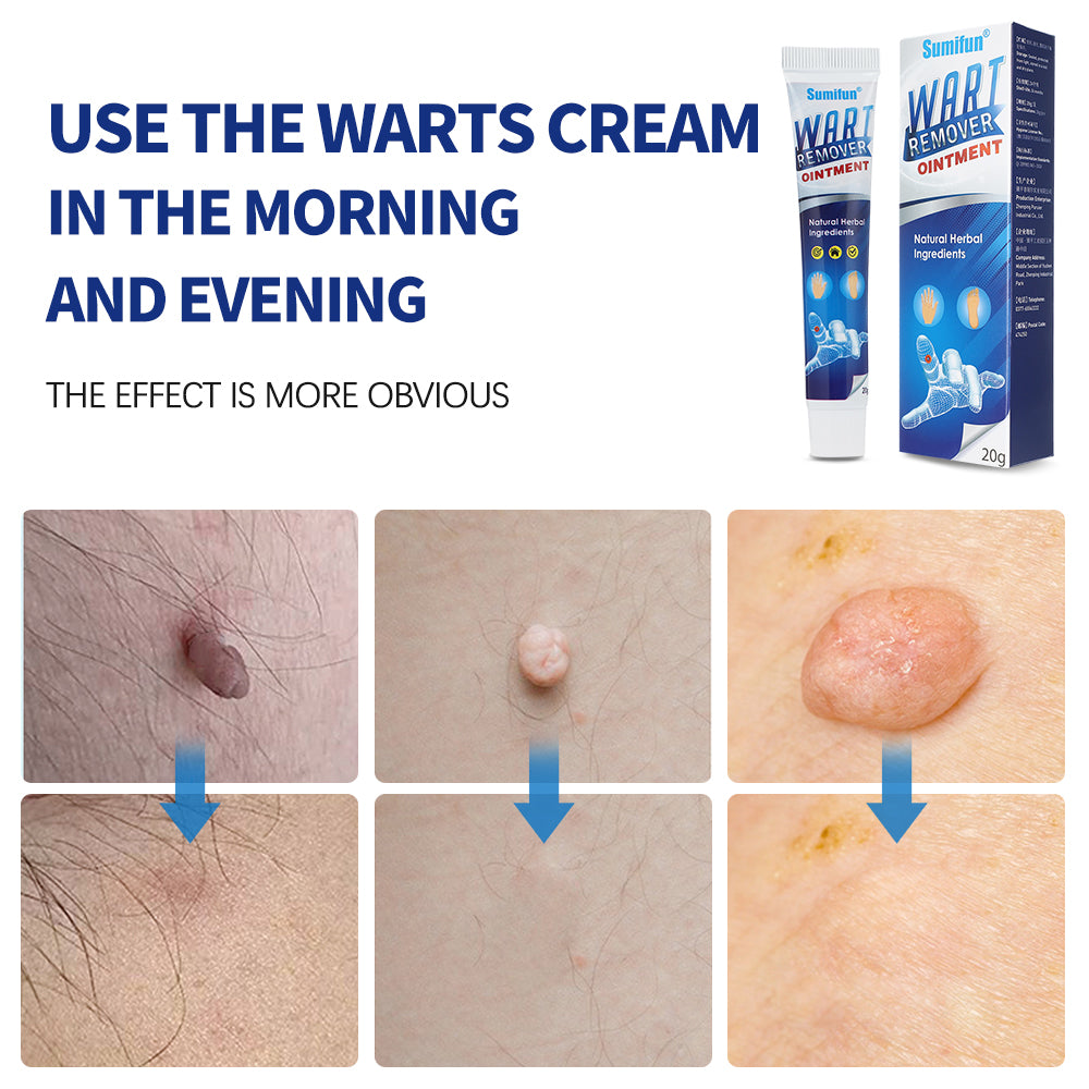 Mieauty Wart Remover Fast Remove All Moles Warts Spots Freckles Foot Corn Removal Warts Papillomas Rapidly Remove Moles, 20G Wart Cream