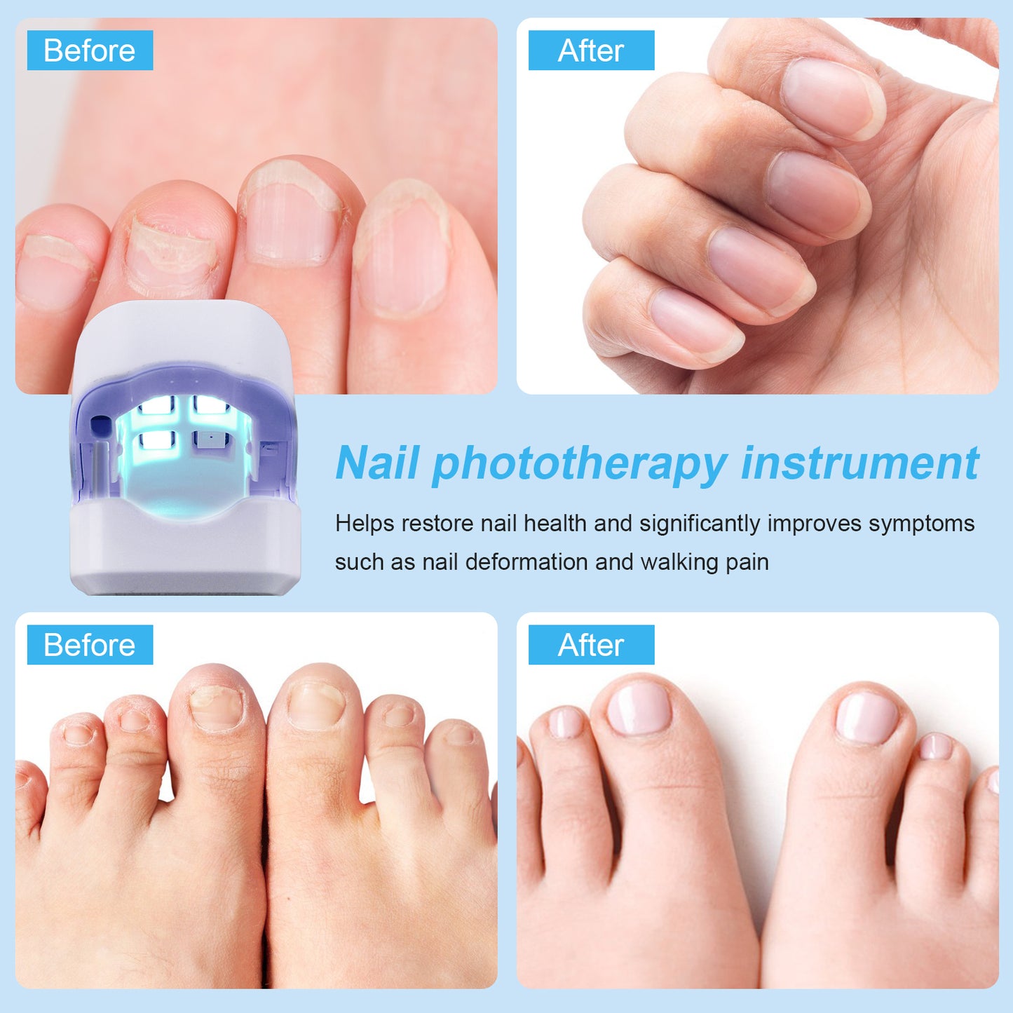 Mieauty Nail Fungus Cleaning Laser Device, Nail Fungus Laser Treatment for Damaged Discolored Thick Toenails & Fingernails, Rechargeable Nail Fungus Remover for Home Use