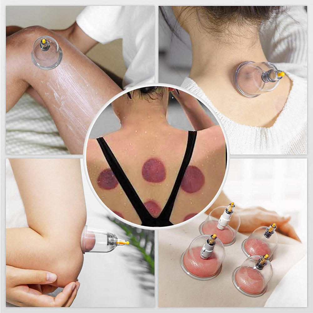Ouwald Cupping Set for Massage Therapy - 22 Cups Chinese Cupping Kit with Hand Pump