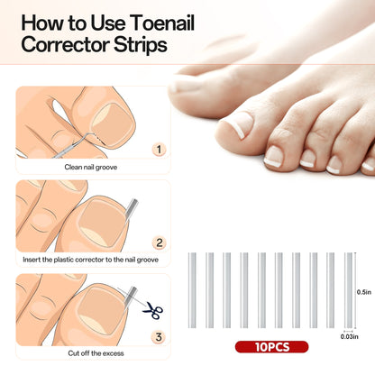 Ouwald Ingrown Toenail Treatment Tools, 84PCS Ingrown Toenail Removal Kit, Ingrown Toenail Corrector, Feet Nail Lift Pedicure Tool