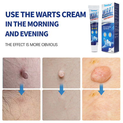 Mieauty Wart Remover Fast Remove All Moles Warts Spots Freckles Foot Corn Removal Warts Papillomas Rapidly Remove Moles, 20G Wart Cream