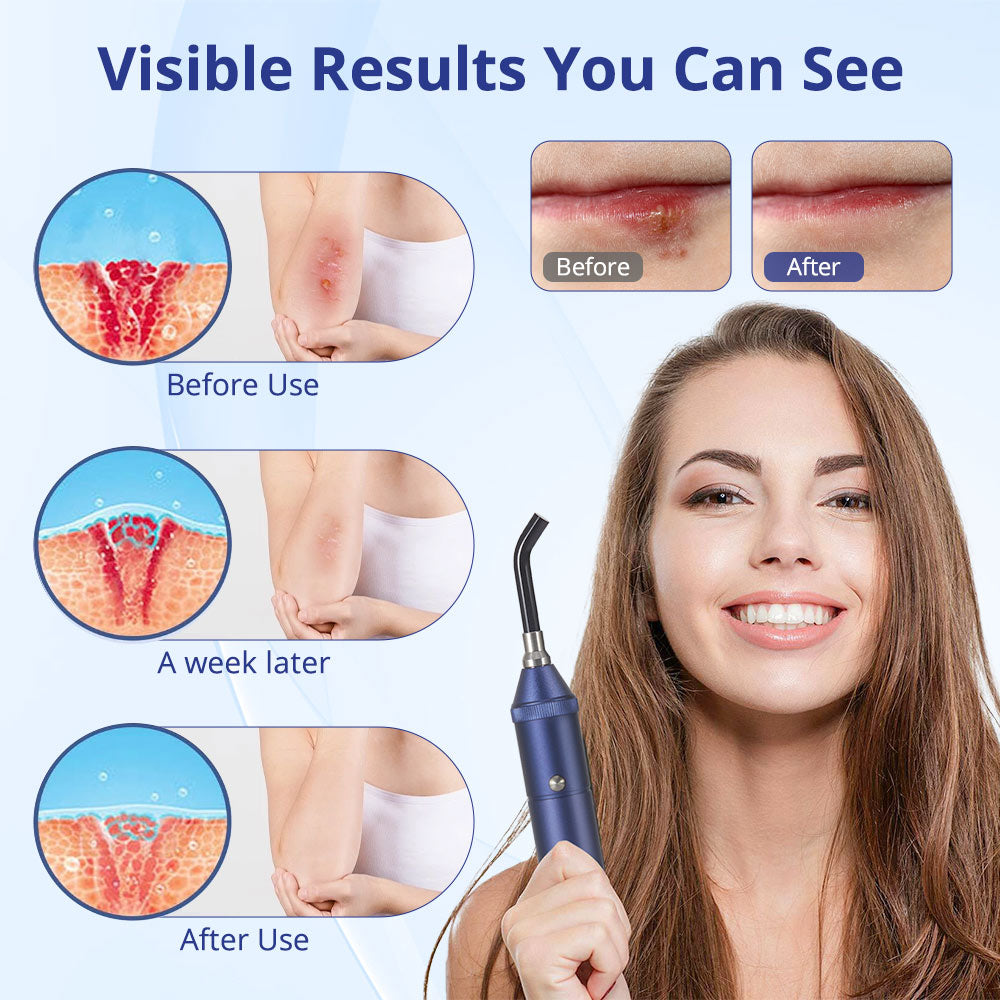 Mieauty Red Light Therapy Device, Cold Sore Canker Sore Treatment Device, Infrared Light Therapy Wand for Lips Mouth Nose Ear Knee Feet Hands Joint Muscle Nerve Pain Relief with Removable Tip