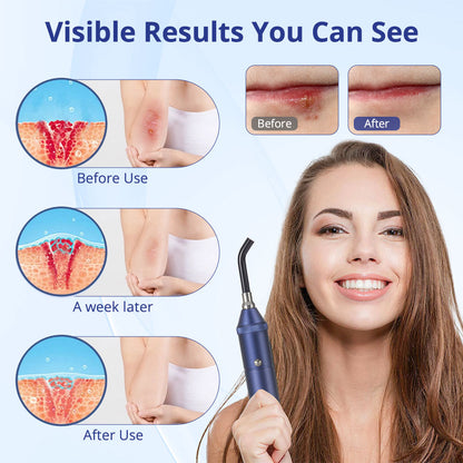 Mieauty Red Light Therapy Device, Cold Sore Canker Sore Treatment Device, Infrared Light Therapy Wand for Lips Mouth Nose Ear Knee Feet Hands Joint Muscle Nerve Pain Relief with Removable Tip